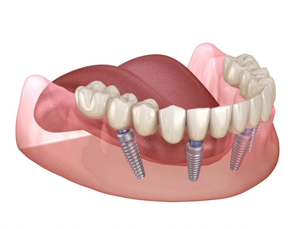 implant tedavisi implant tedavisi