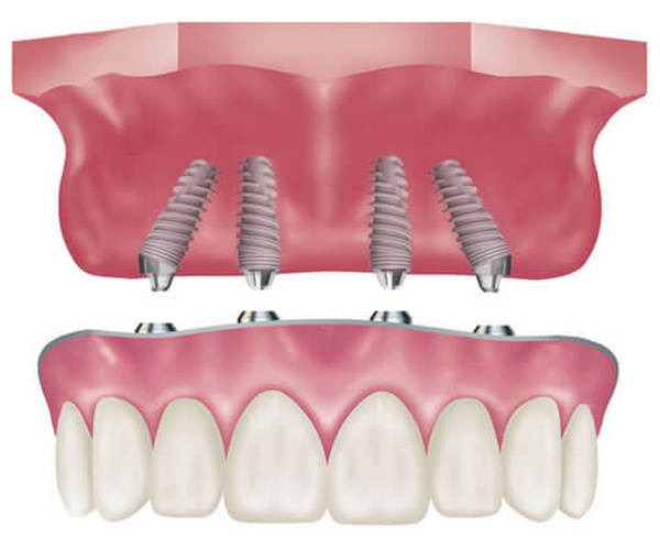 implant tedavisi implant tedavisi
