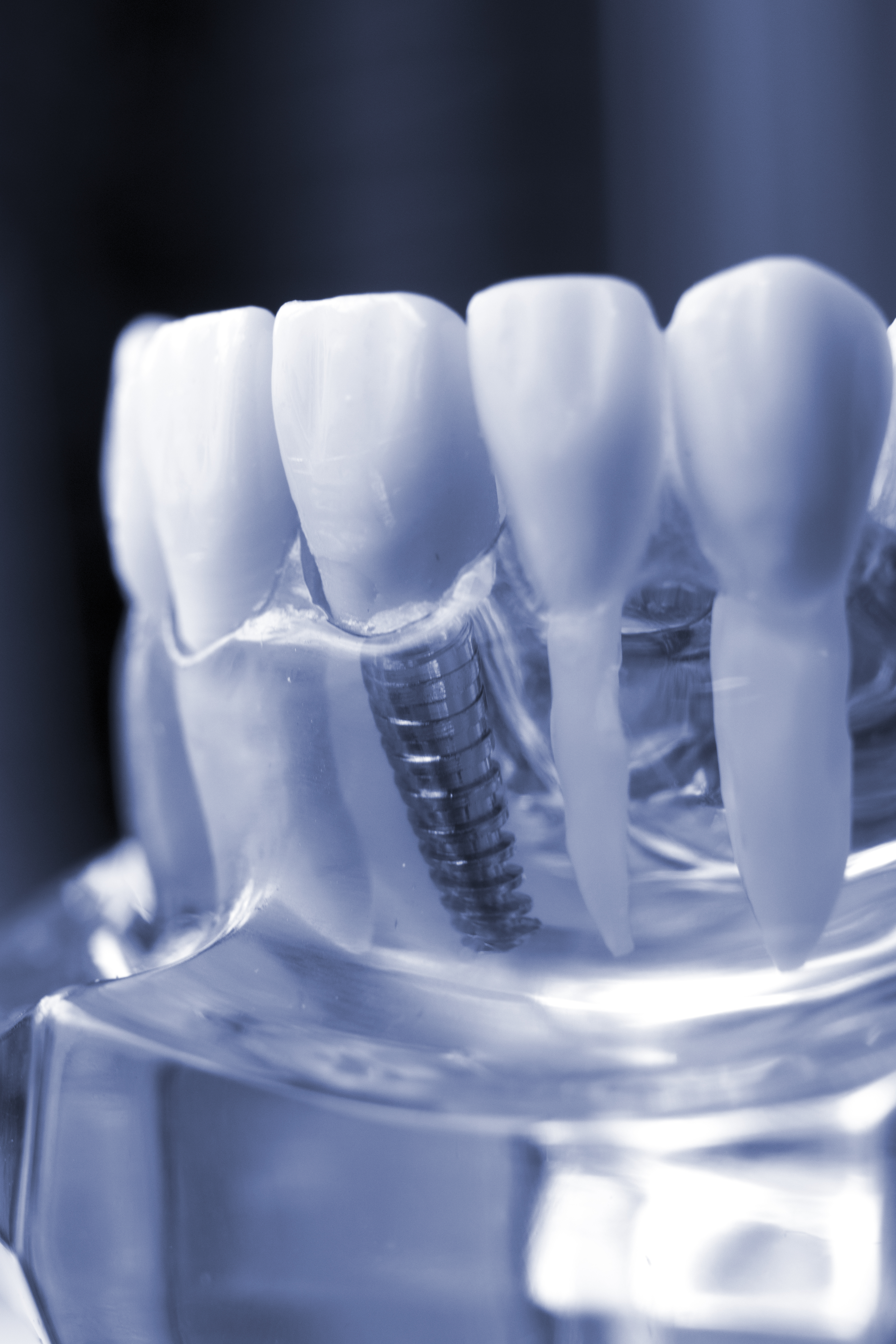 implant tedavisi implant tedavisi