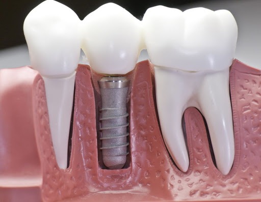 titanyum implant kanser yapar mı titanyum implant kanser yapar mı