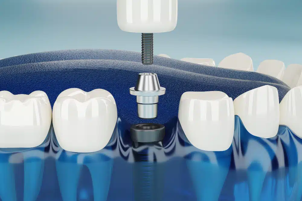 Ankara implant tedavisi All on 4 Tek diş desteği